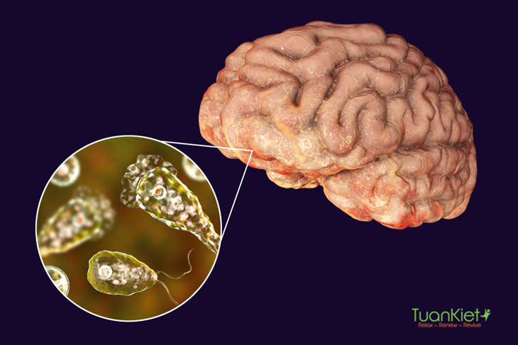 Bệnh amip ăn não: Khái niệm, nguyên nhân, dấu hiệu và cách chữa