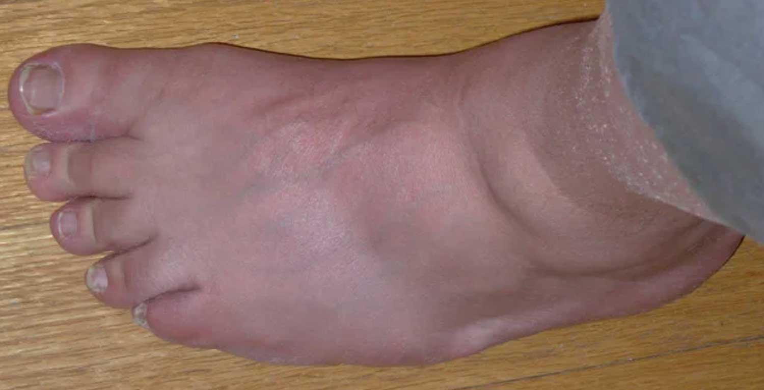 Bệnh Gút: Triệu chứng, nguyên nhân và cách điều trị