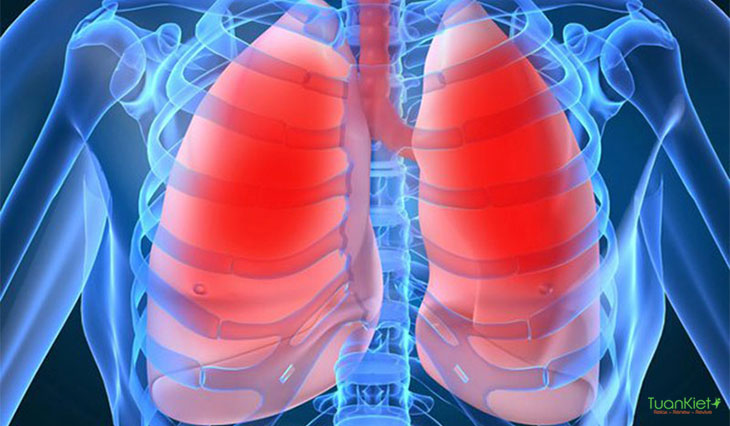 Bệnh lao phổi là gì và nó có nguy hiểm không