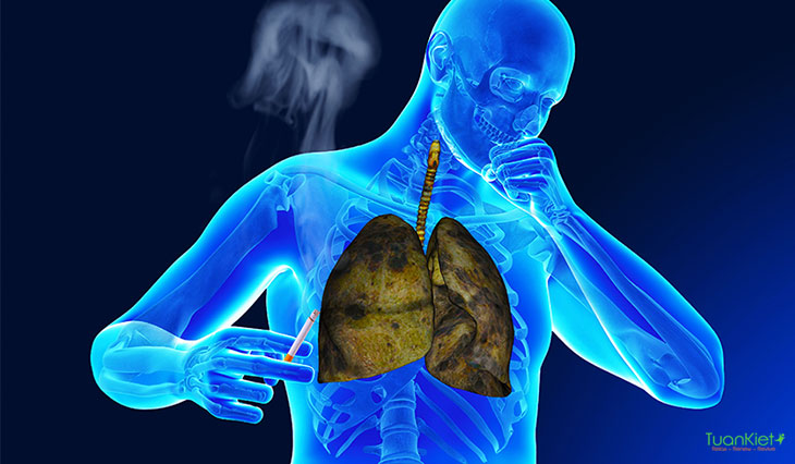 Hút thuốc là một trong những nguyên nhân gây căn bệnh lao phổi nguy hiểm