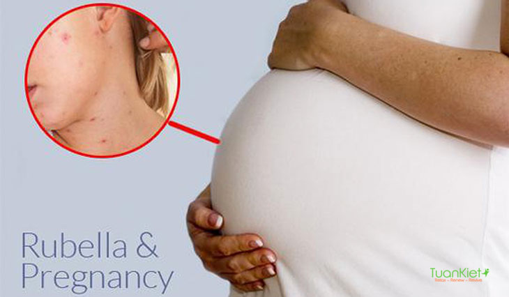 Rubella gây biến chứng ở phụ nữ có thai