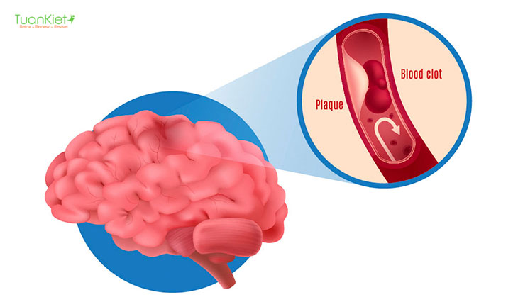 Sa sút trí tuệ não mạch là những hư hại mạch máu trong não